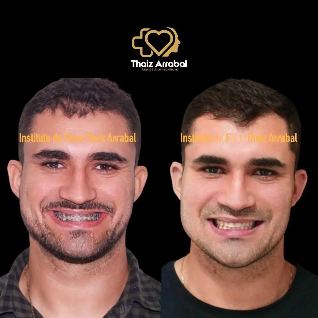 Antes e depois — registro clínico 25 do Instituto da Face