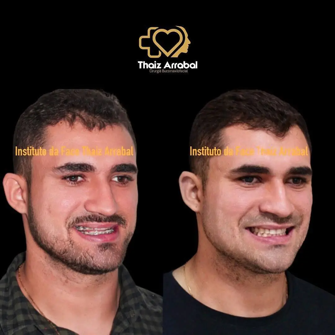Antes e depois — registro clínico 23 do Instituto da Face