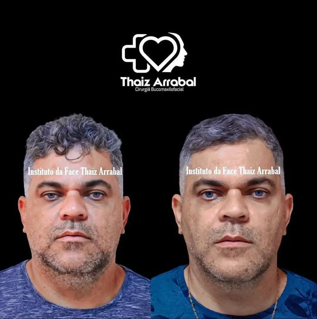 Antes e depois — registro clínico 16 do Instituto da Face
