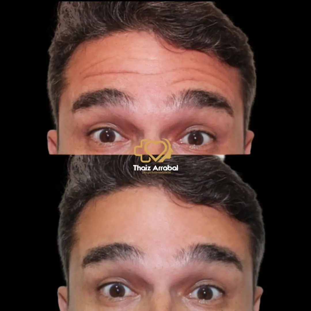 Antes e depois — registro clínico 26 do Instituto da Face