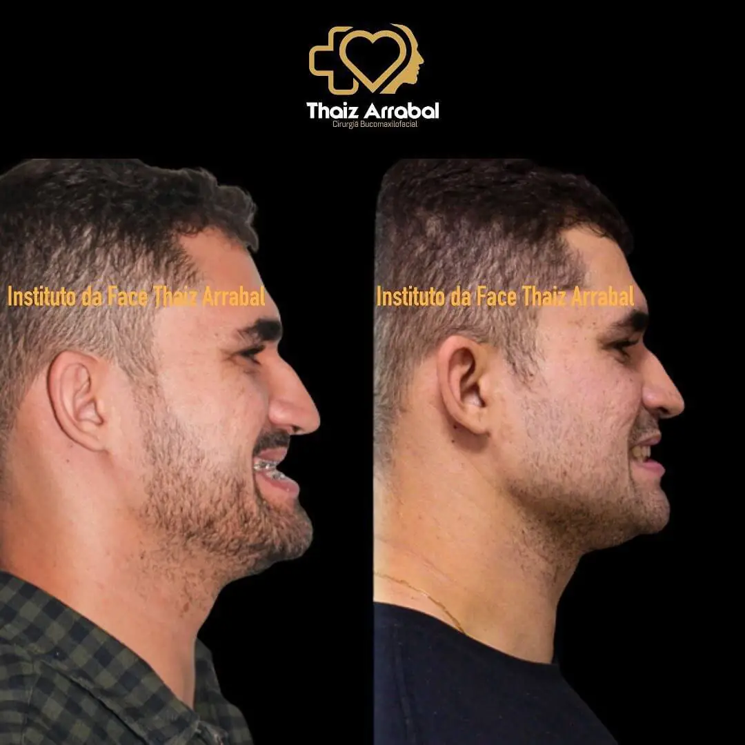 Antes e depois — registro clínico 22 do Instituto da Face