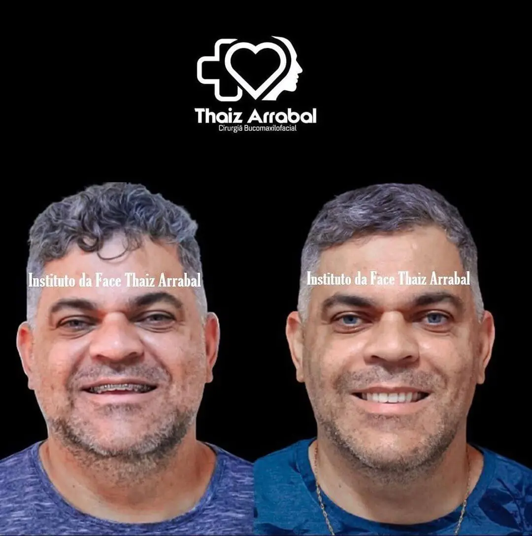 Antes e depois — registro clínico 12 do Instituto da Face