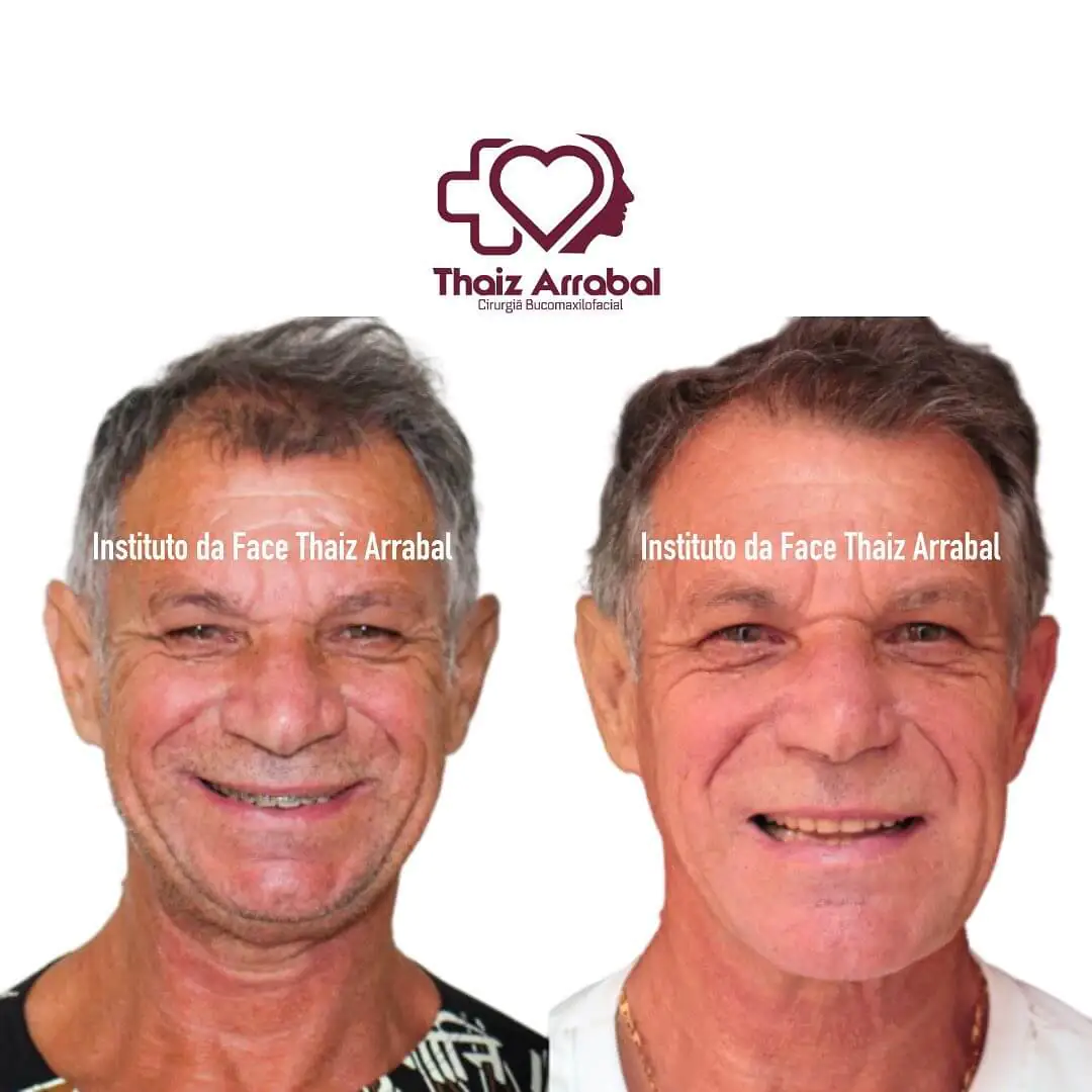 Antes e depois — registro clínico 10 do Instituto da Face