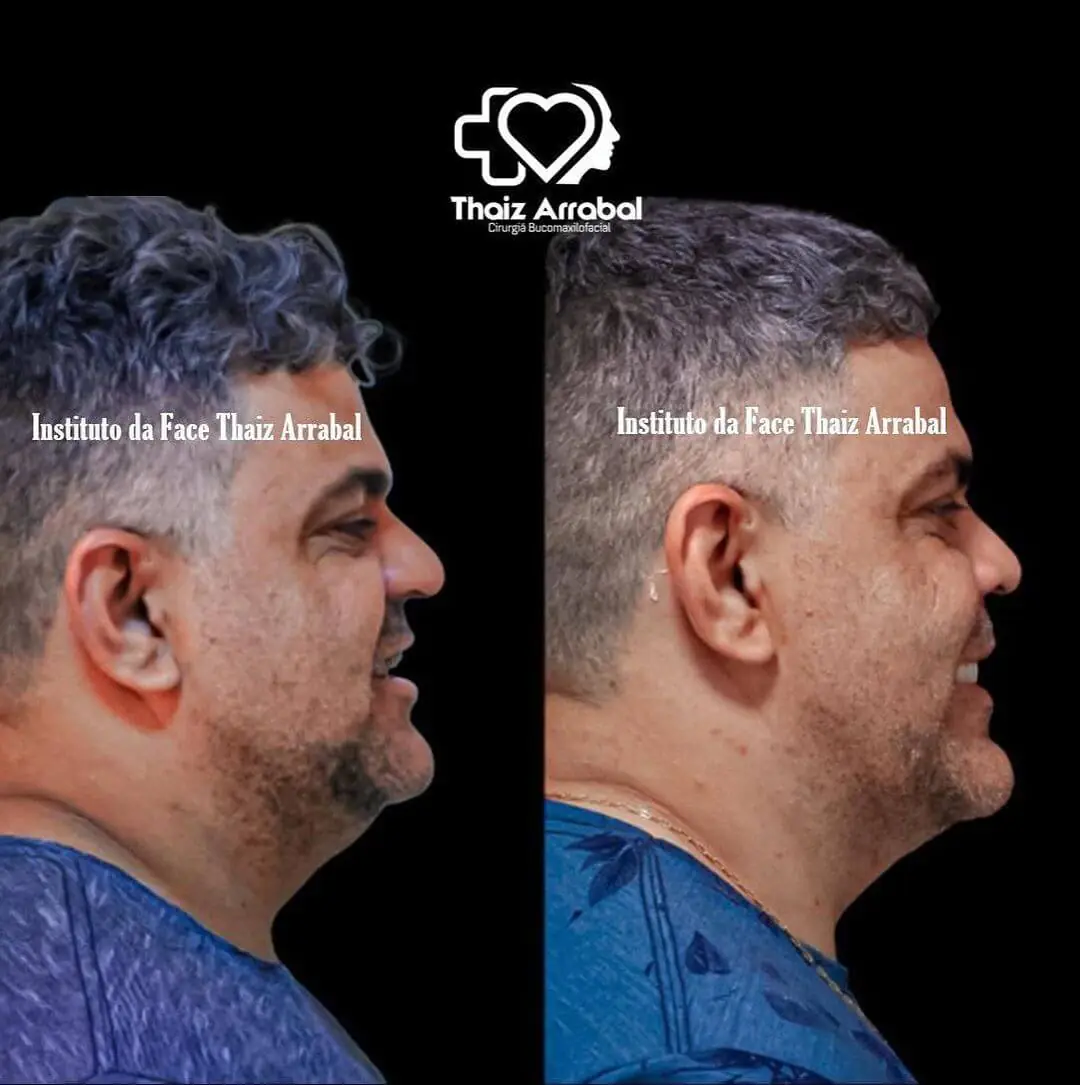 Antes e depois — registro clínico 14 do Instituto da Face
