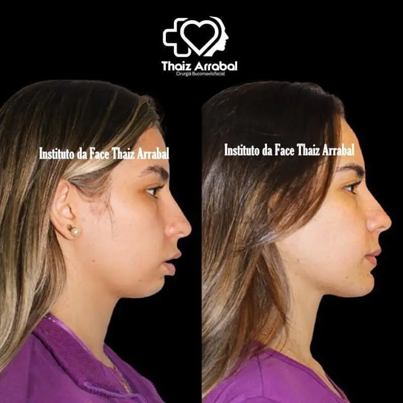 Antes e depois — registro clínico 8 do Instituto da Face