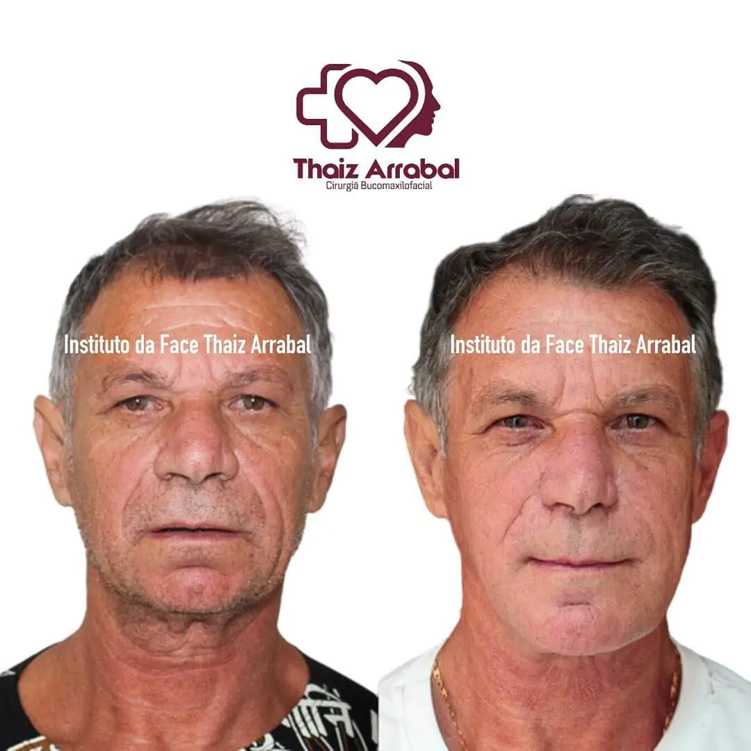 Antes e depois — registro clínico 9 do Instituto da Face