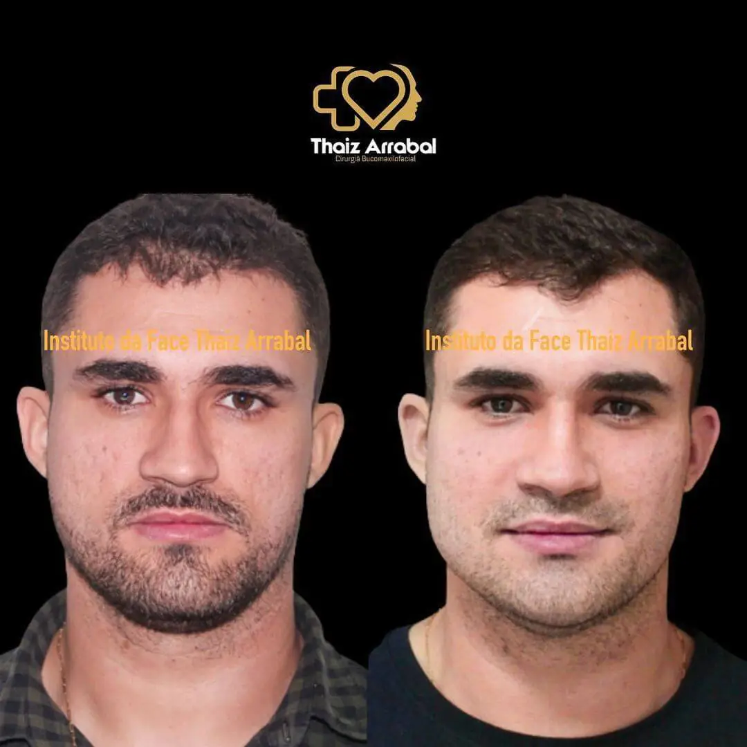 Antes e depois — registro clínico 24 do Instituto da Face