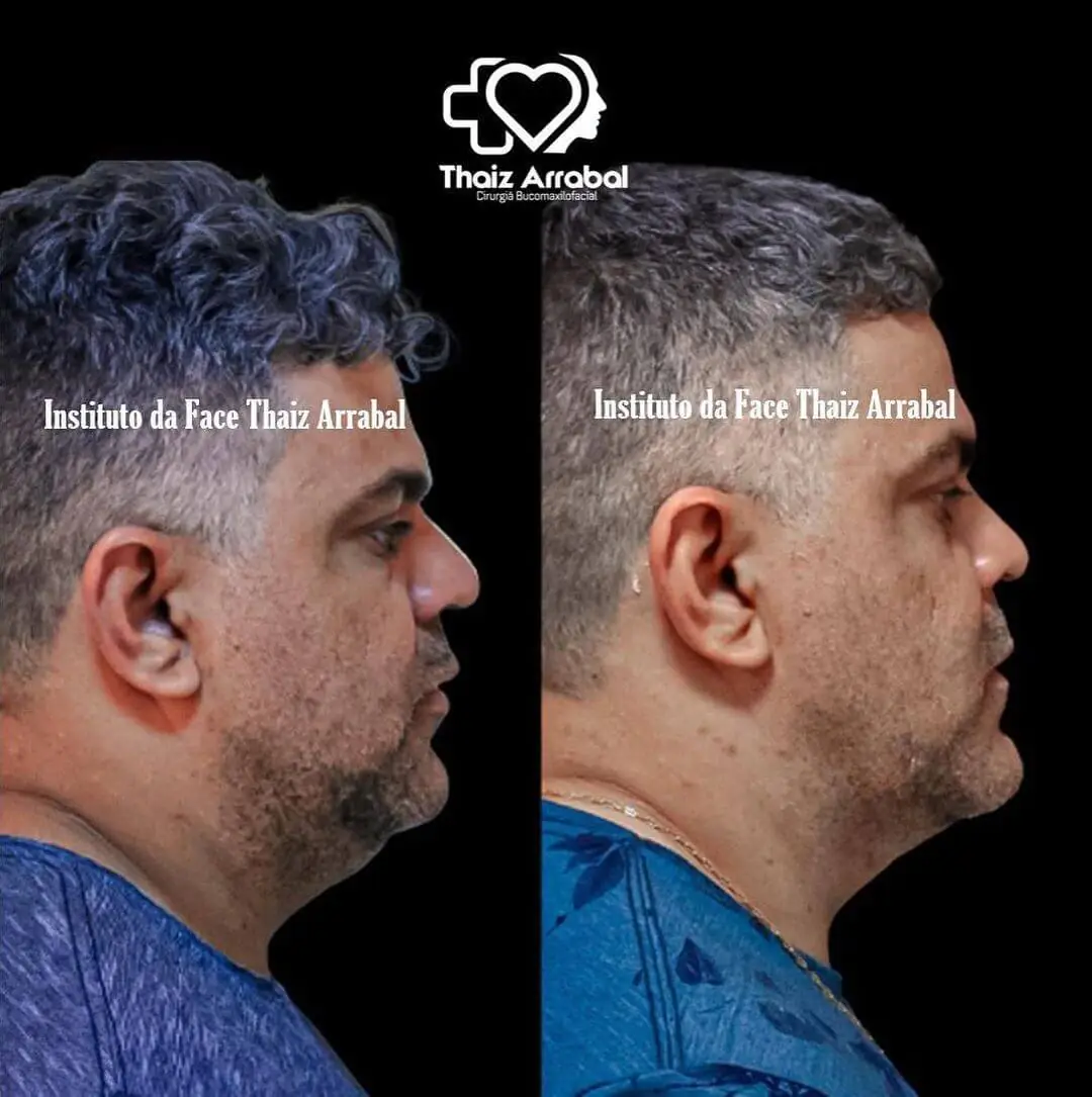 Antes e depois — registro clínico 15 do Instituto da Face